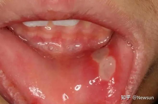 溃疡不愈查出舌癌,溃疡不愈查出舌癌怎么办